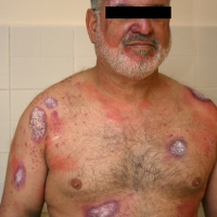 Casualty-Effects-psoriasis-2