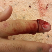 Casualty-Effects-severed-finger-tip