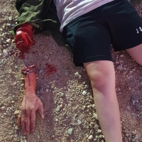 פציעות-וחבלות-יד-קטועה