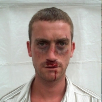 פציעות-וחבלות-תאונת-דרכים