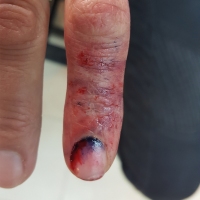 Casualty-Effects-bruised-finger