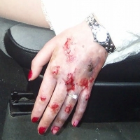 Casualty-Effects-damaged-hand