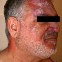 Casualty-Effects-psoriasis-1