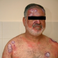 Casualty-Effects-psoriasis